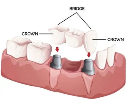Dental Crowns Treatment